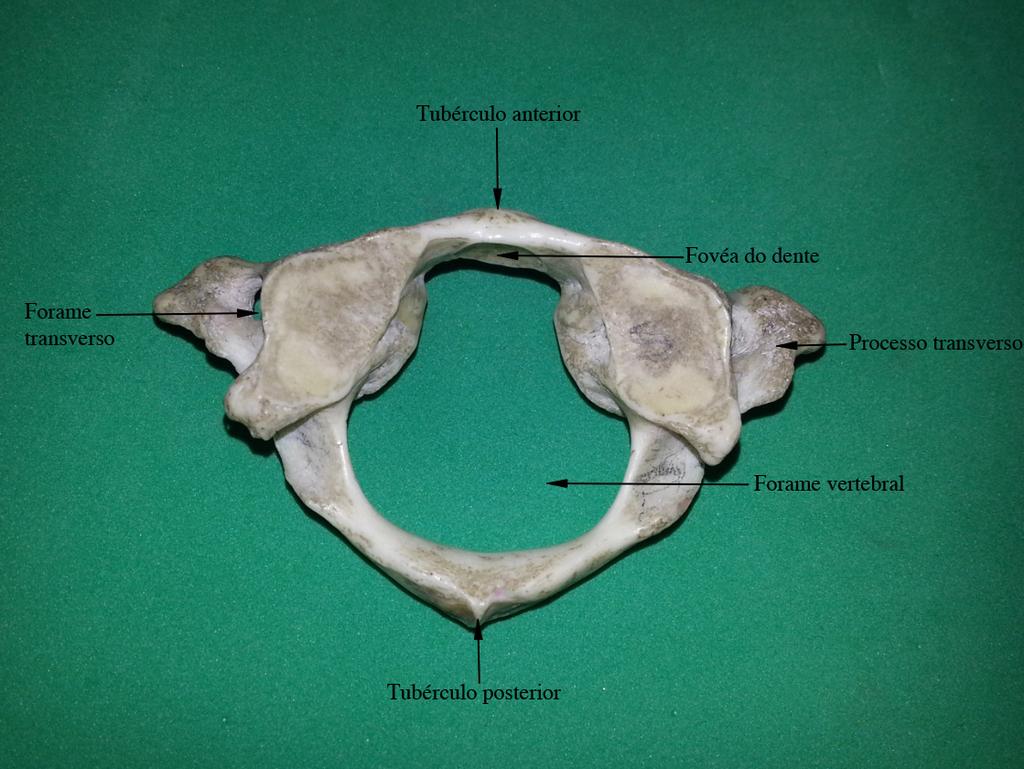 Figura 5. Atlas Entre os arcos vertebrais da atlas (Figura 5) encontra-se a face articular para o dente do áxis, segunda vértebra cervical.