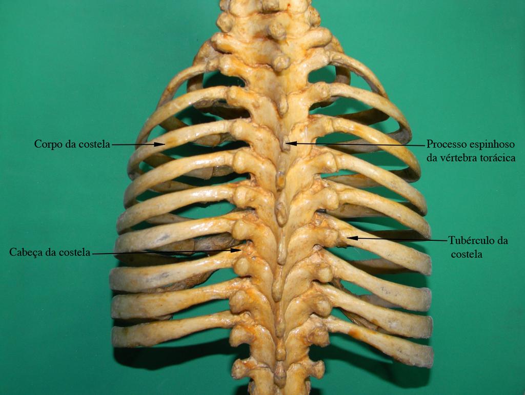 Figura 13. Coluna vertebral e gradil costal (vista posterior) A articulação costovertebral é uma articulação sinovial, contendo cápsula articular, cavidade articular e líquido sinovial.