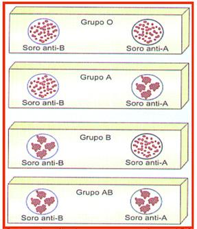 Observe no quadro abaixo os grupos sanguíneos do sistema ABO, com os aglutinogênios (antígenos) e as aglutininas (anticorpos) que possuem.
