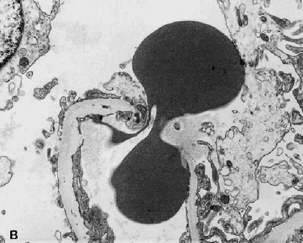 Collar JE et all. Red cell traverse through thin glomerular basement membranes. Kidney International, Vol. 59 (2001), pp. 2069 2072.