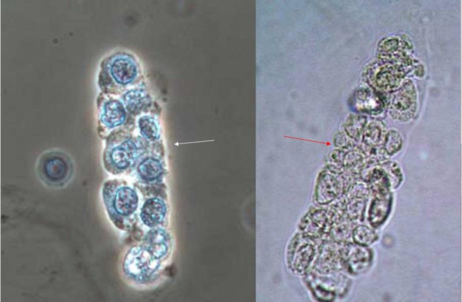 Questão 4 Pacientes com hematúria de origem glomerular apresentam um perfil urinário geralmente nefrítico (caracterizado pela presença de eritrócitos com dismorfismo, cilindros eritrocíticos,