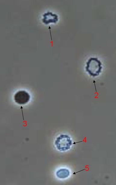 Para a correta identificação dos eritrócitos dismórficos a amostra deve ser: 1. Encaminhada para o setor analítico juntamente com as amostras de rotina. 2.