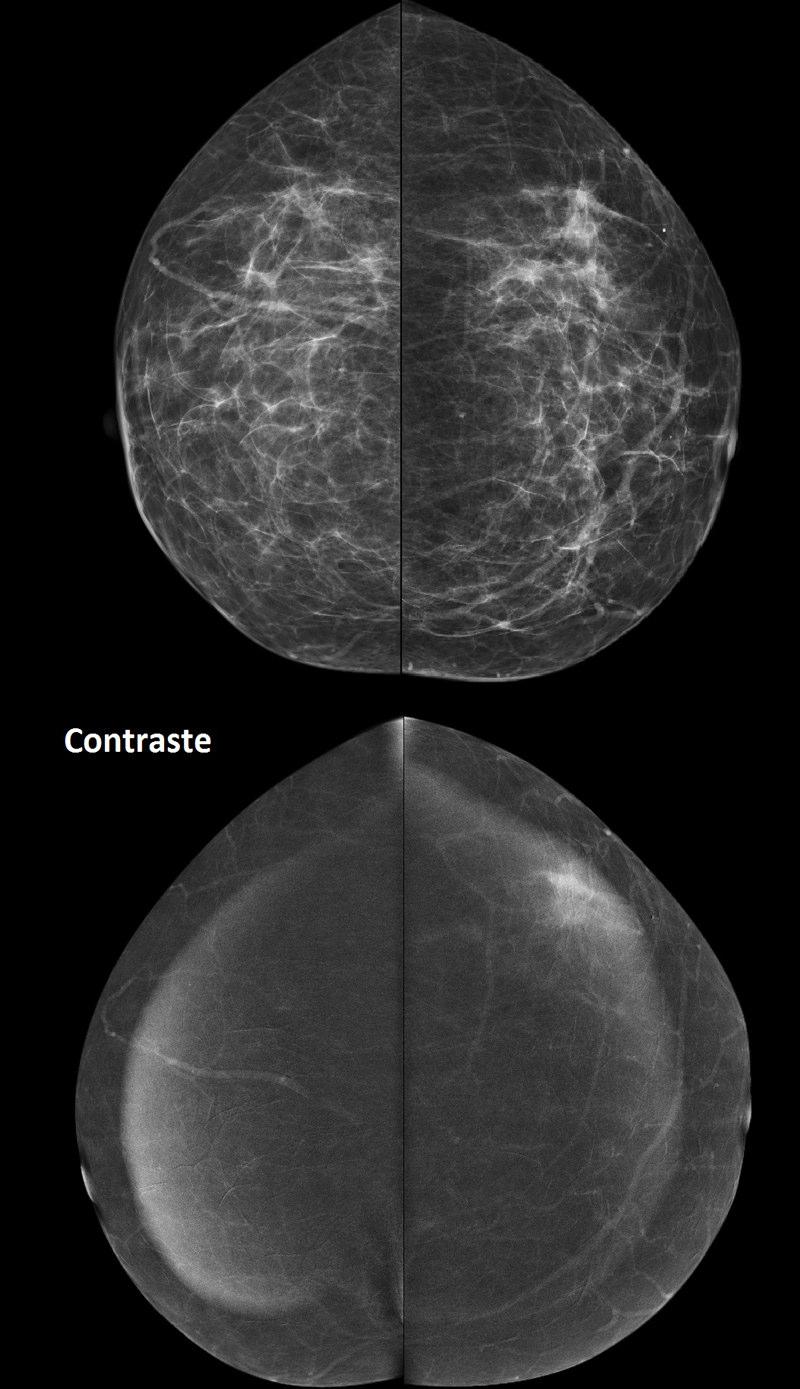 Fig 2 - Lesão equívoca. Doente de 57 anos seguida na consulta de Senologia por desconforto mamário esquerdo. Incidência crânio-caudal bilateral antes e após contraste.