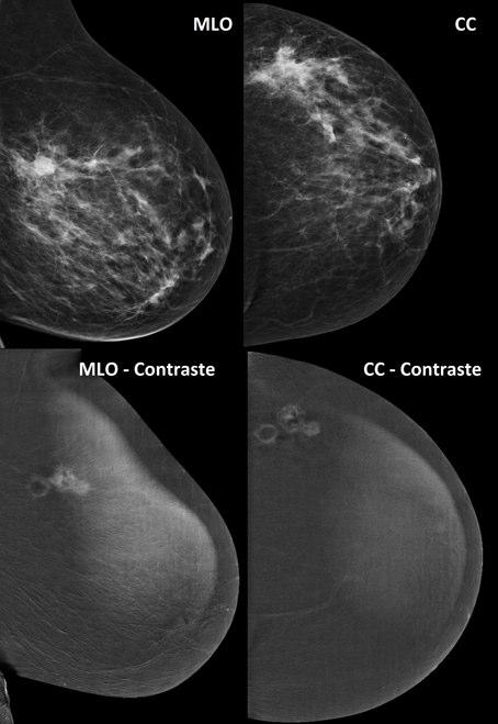 Mama direita em incidências médio-lateral oblíqua (MLO) e crânio-caudal (CC) antes e após contraste.
