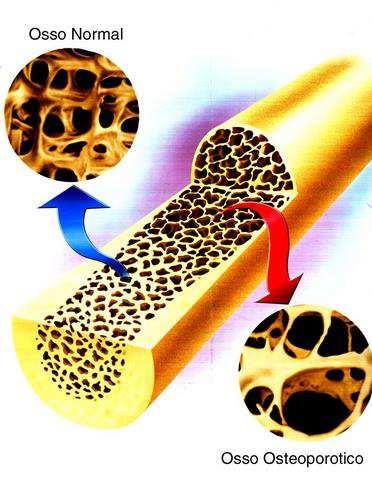 Osteoporose A osteoporose é uma doença generalizada do esqueleto que se caracteriza pela diminuição da densidade e qualidade do tecido ósseo, conduzindo ao aumento da fragilidade e ao risco de