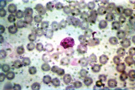vivax com numerosas granulações de Schüffner (hemácias dilatadas) Foto 10
