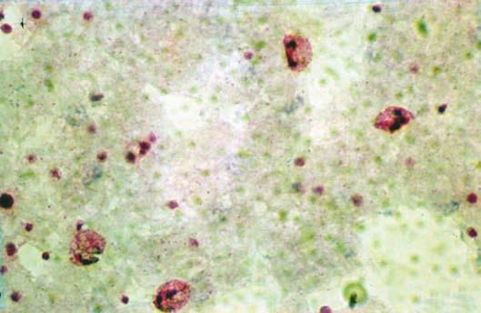 vivax, com granulações de Schüffner nas hemácias parasitadas Foto 16 gota