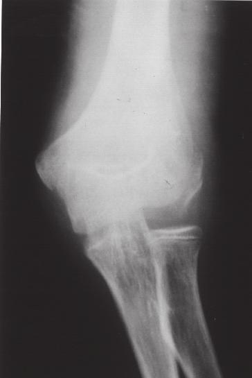 2 Radiografia ântero-posterior do cotovelo, mostrando o duplo contorno da superfície articular O diagnóstico, algumas vezes, não é fácil e essa fratura pode passar despercebida no primeiro