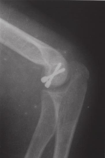 FRATURAS DO CAPÍTULO UMERAL Fig. 5 Radiografia ântero-posterior pós-operatória da paciente nº 5 Fig.