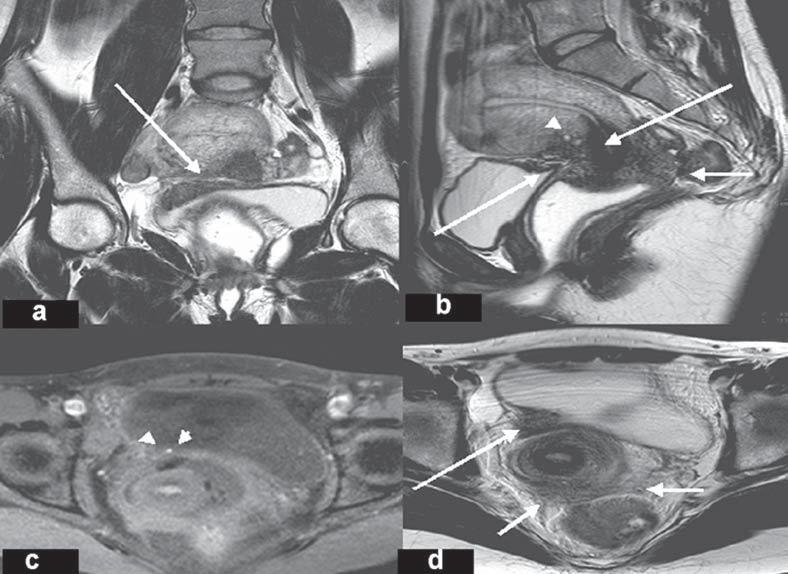 Ressonância magnética na endometriose pélvica profunda: ensaio iconográfico sas lesões, é responsável pelo realce variável no pós-contraste (4,7).