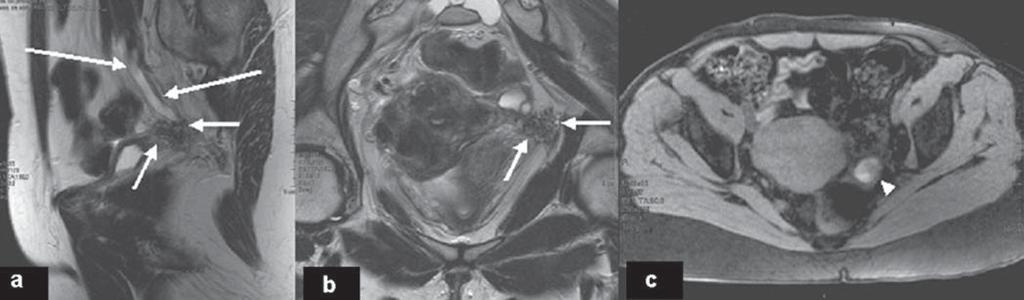 Coutinho Junior AC et al. Figura 5. Imagens pesadas em T2 nos planos sagital (a) e coronal (b) e pesadas em T1 com supressão de gordura no plano axial (c) evidenciam endometriose ureteral.