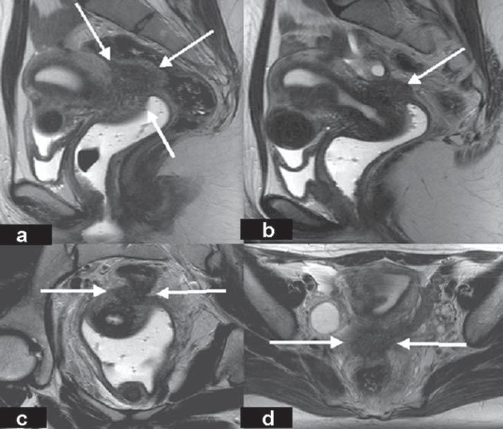 Ressonância magnética na endometriose pélvica profunda: ensaio iconográfico Figura 7.