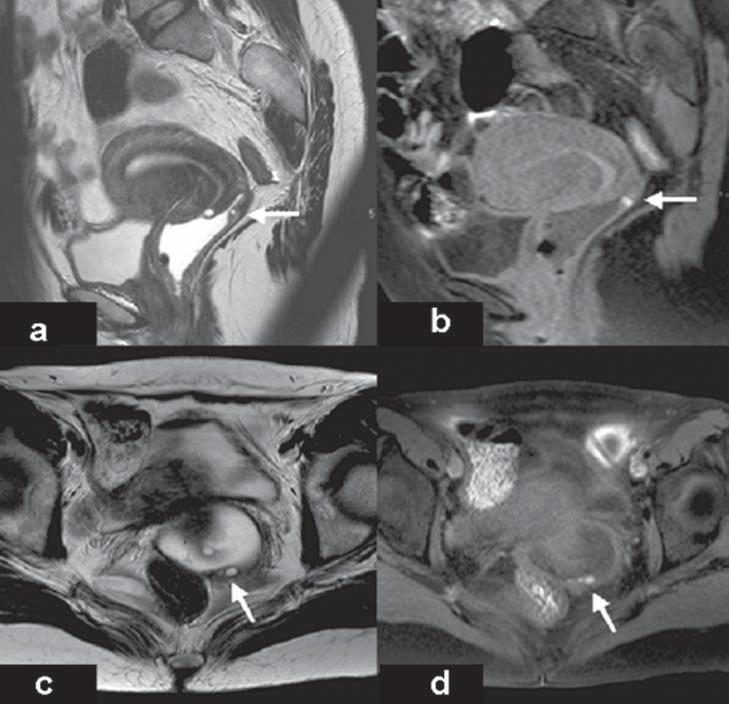 RM evidencia espessamento nodular hipointenso nas seqüências pesadas em T2 da parede posterior da porção profunda da vagina, com focos de sangramento de permeio (setas). Figura 8.