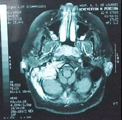 Na otoscopia, a MT estava espessada e opacificada à direita, com discreto aumento da vascularização e a fundoscopia apresentava-se normal.