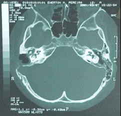 intracraniana mais comum.