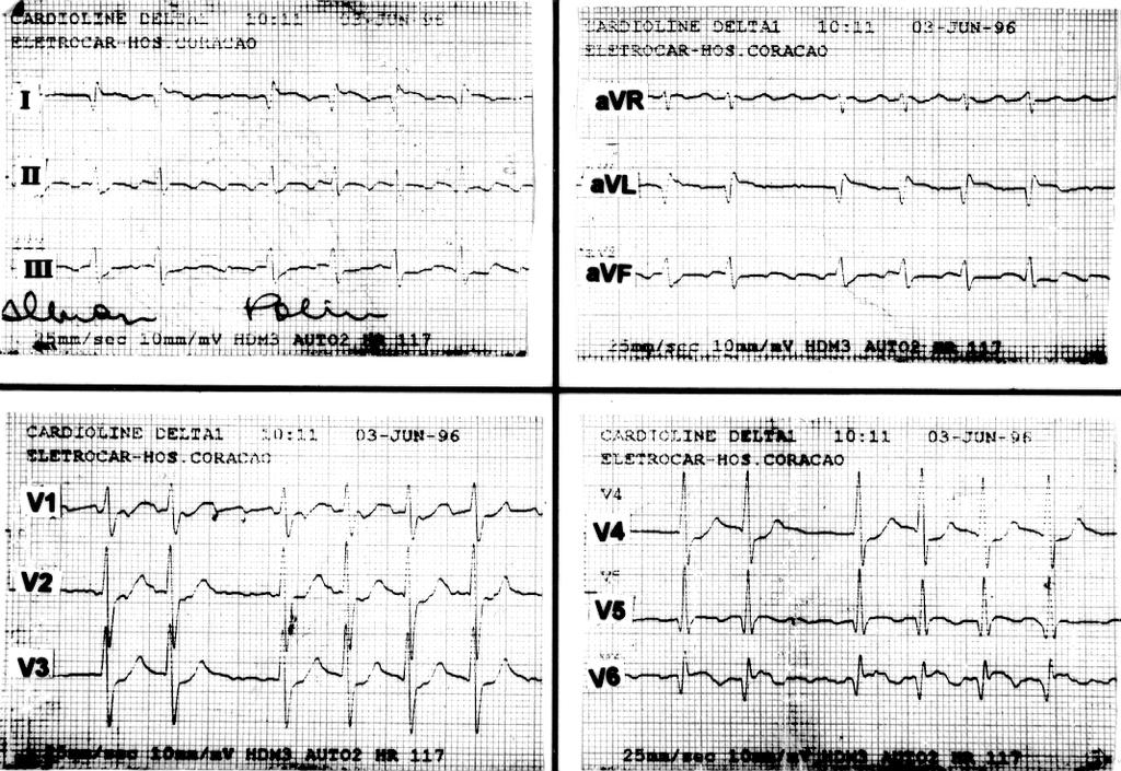 Arq Bras Cardiol Fig 1 - Eletrocardiograma inicial mostrando ritmo de fibrilação atrial, necrose e corrente de lesão subepicárdica em