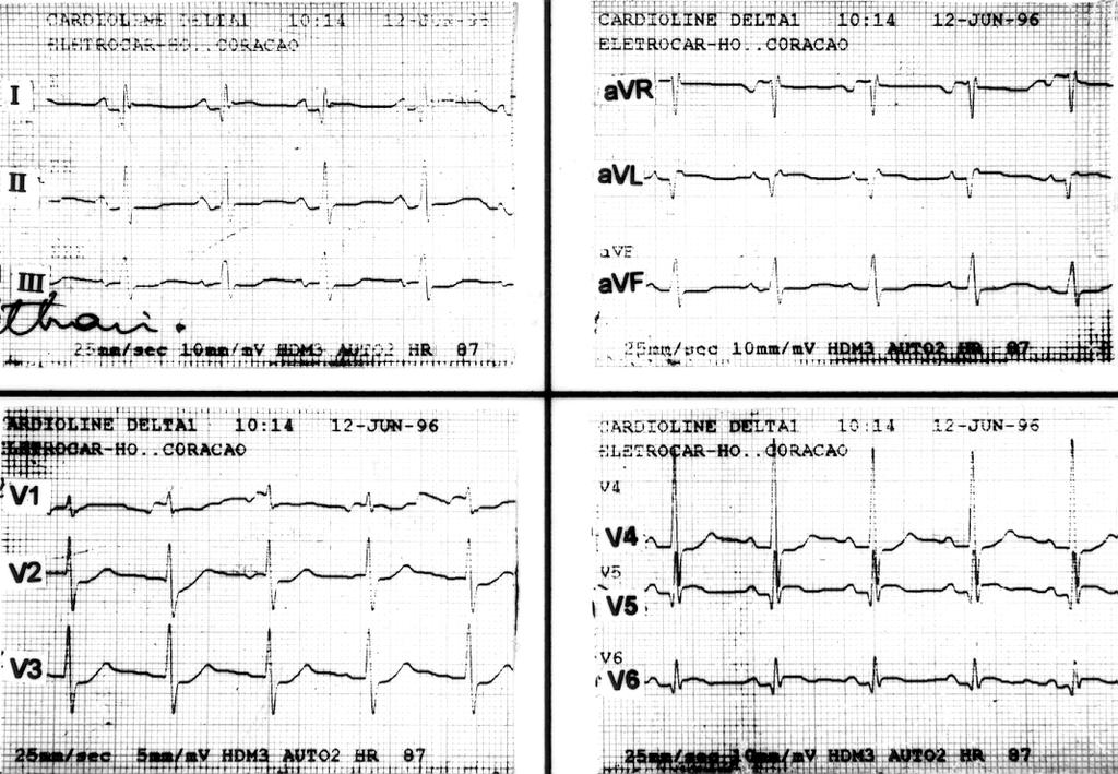 diagnóstico de infarto atrial: ECG de controle mostrou ritmo sinusal, com necrose e corrente de lesão subepicárdica lateral e lateral