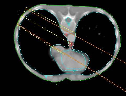 Figura 2. Corte axial de tomografia do tórax de um paciente mostrando uma lesão de esôfago, localizada entre os dois pulmões. 2. METODOLOGIA Informações sobre o alvo e o flatterning filter e os colimadores primário e secundário do Clinac 2100 da VARIAN foram pesquisados.