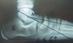 O tendão calcâneo encurtado foi alongado percutaneamente por meio de quatro hemissecções, após as quais realizou-se flexão dorsal até º, evitando hipercorreção.