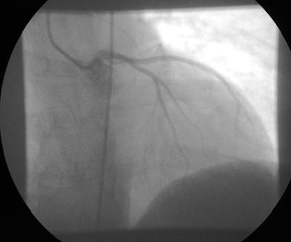 A B Figura 3: (A) Cineangiocoronariografia de artéria coronária esquerda em projeção oblíqua anterior direita, demonstrando ausência de lesões obstrutivas em seus ramos.