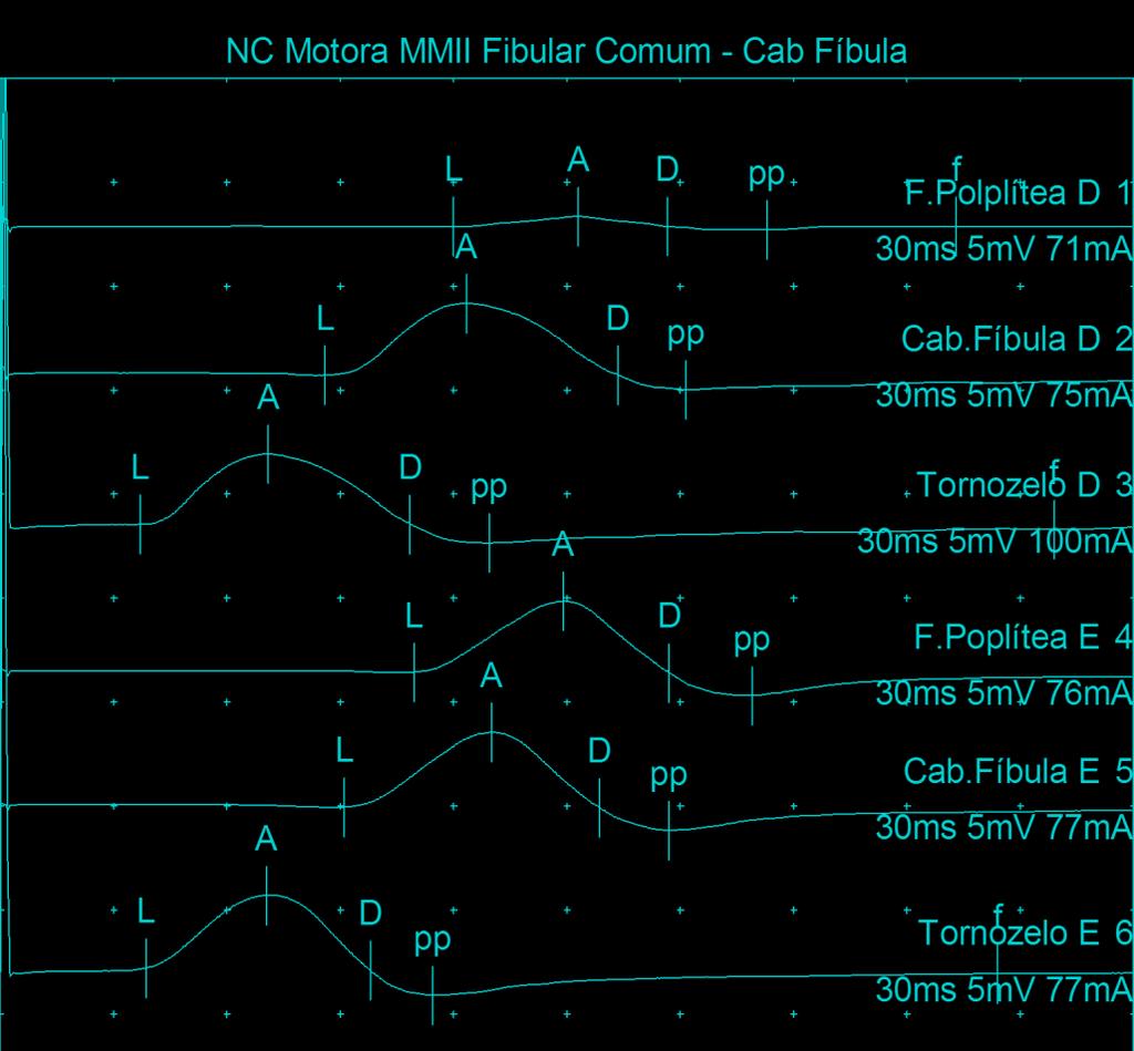 NC Motora MMII Roldão Coelho Nerve / Sites Captação Lat Amp Dur. Area Dist. Vel. ms mv ms mvms cm m/s Fibular Comum - Cab Fíbula F.Polplítea D ECA D 12,00 0,5 5,65 1,4 Cab.