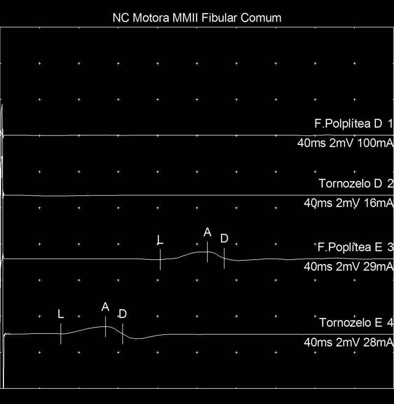 NC Motora MMII Roldão Coelho Nerve / Sites Captaçã o Lat Amp Dur. Area Dist. Vel. ms mv ms mvms cm m/s Fibular Comum - Cab Fíbula F.Polplítea D ECA D 12,00 0,5 5,65 1,4 Cab.