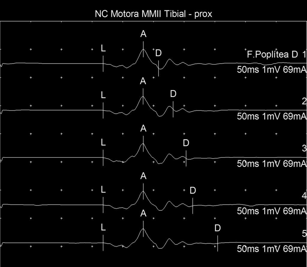 Nerve / Sites Captação Lat Amp Dur. Area Dist. ms mv ms mvms cm Tibial - prox F.