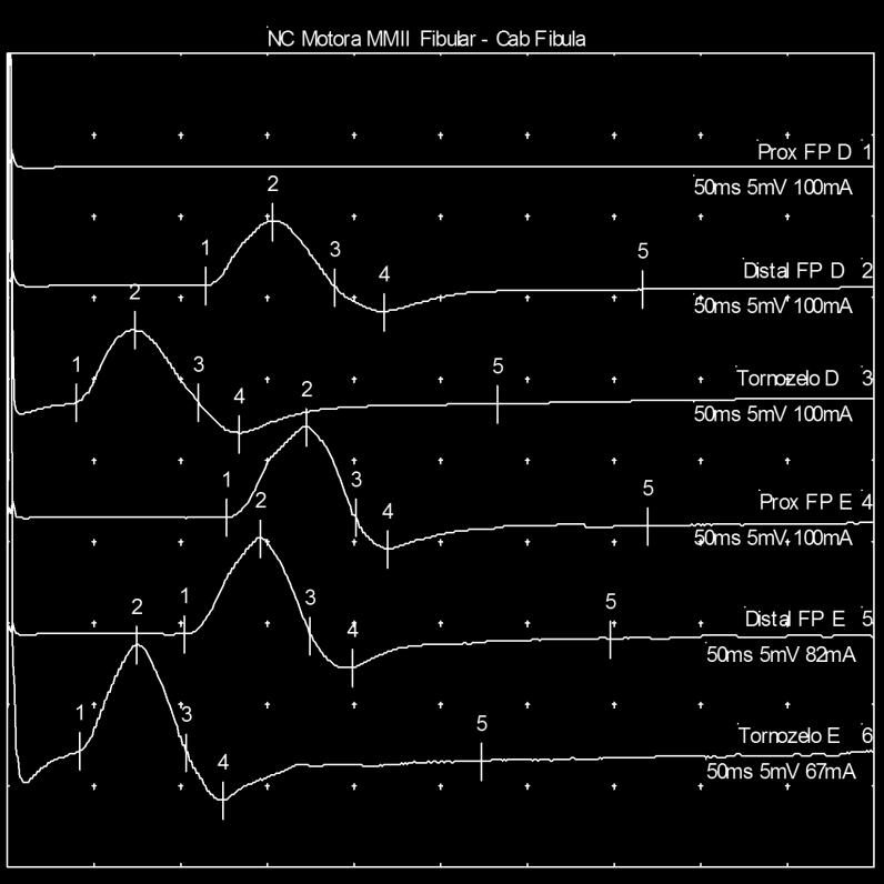 NC Motora MMII Nerve / Sites Lat. Amp. Dur. Area Dist. Vel. ms mv ms mvms cm m/s Fibular - Cab Fibula 1. Prox FP D NR NR NR NR 2.