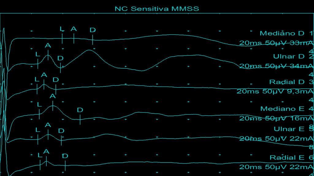 NC Sensitiva Nerve / Sites Captação Lat Amp. Dur. Area Dist. Vel.