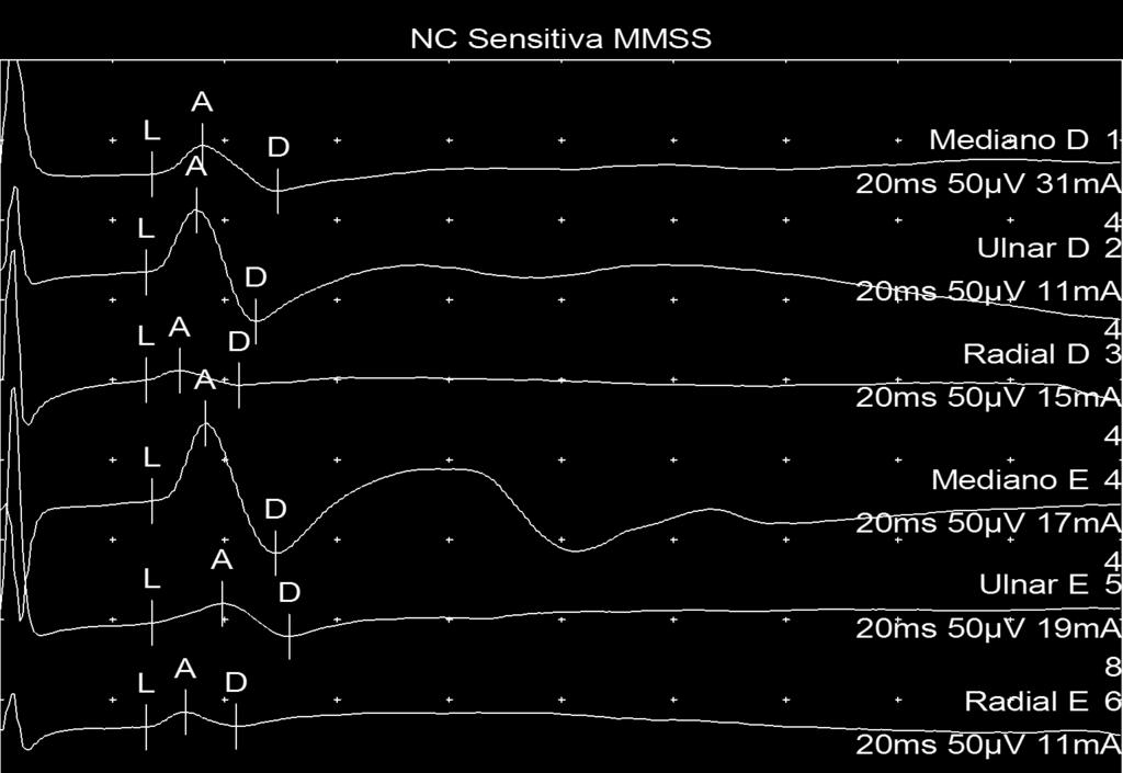 NC Sensitiva Nerve / Sites Captação Lat Amp. Dur. Area Dist. Vel.