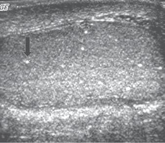 Vital RJ et al. Figura 1. Forma discreta de microlitíase testicular. Observam-se pequenos pontos ecogênicos (seta) esparsamente distribuídos pelo parênquima (calcosferitas).