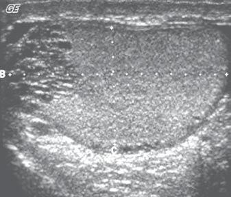 Aspectos ultra-sonográficos das alterações não-neoplásicas do testículo Ao estudo com mapeamento por Doppler colorido é observado refluxo venoso à manobra de Valsalva, que é patognomônico (1,19).