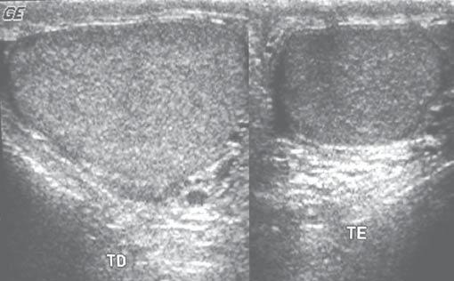 Vital RJ et al. descido pode estar situado desde o hilo renal até o canal inguinal. Em um terço dos casos é bilateral, porém quando unilateral, o lado direito é o mais freqüentemente acometido.