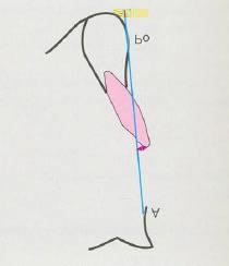 Fator 5 Posição do incisivo inferior: Distância entre a borda incisal do incisivo inferior e o plano A-Po medida paralelamente ao