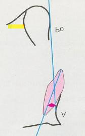 Fator 7- Inclinação do incisivo inferior: Ângulo formado pelo longo eixo do incisivo inferior e o plano A-Po.