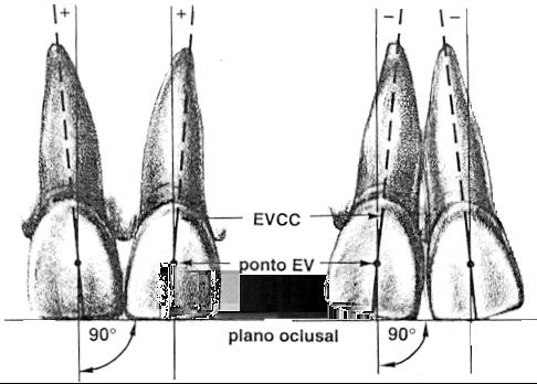 18 REVISÃO DA LITERATURA 5) Angulação da Coroa: é o ângulo formado pelo eixo vestibular da coroa clínica (EVCC) e uma linha perpendicular ao plano oclusal.