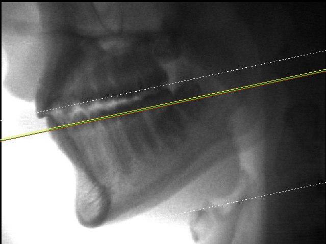 68 MATERIAL E MÉTODO O plano oclusal utilizado tinha como referência na região anterior, a intersecção entre as bordas incisais dos incisivos centrais superior e inferior, e na região posterior, a