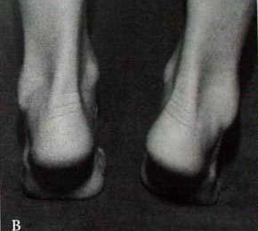 10 Teste da ponta dos pés: positiva e normal quando ao se elevar nas pontas dos pés, observa-se as