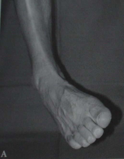 INTRODUÇÃO Supinação do pé: flexão do TNZ + inversão da