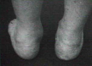 MANOBRAS E TESTES ESPECIAIS 14 Sinal dos muitos dedos ( too many toes ): indica presença de deformidade em abdução do ante pé com relação