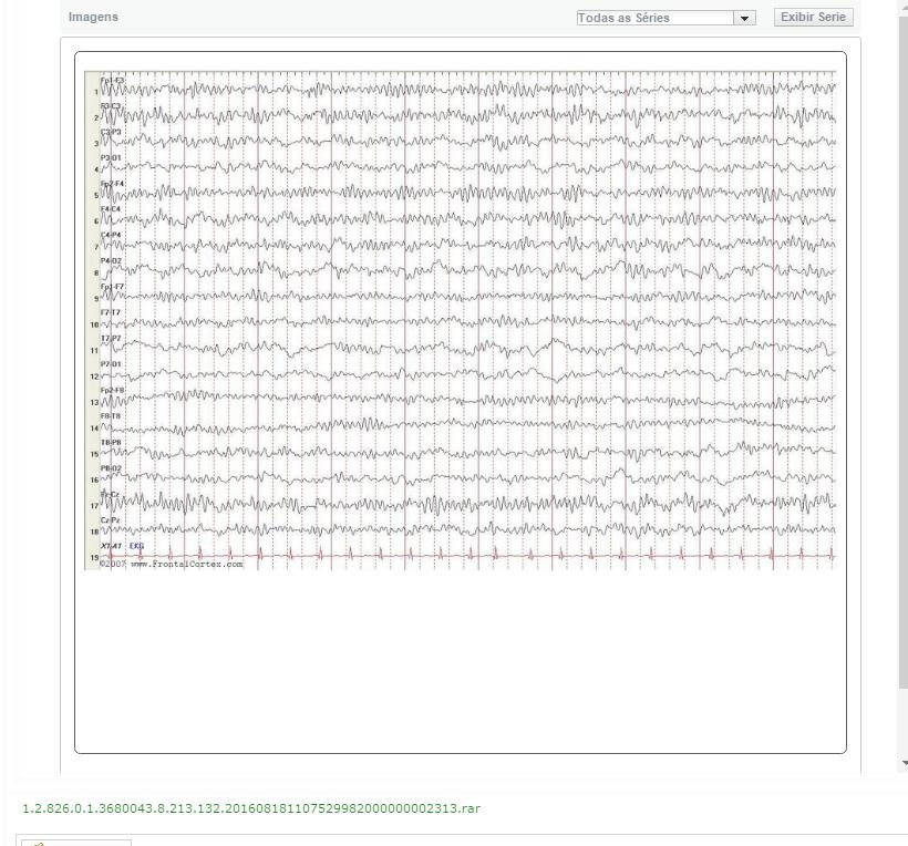 1.9 Além de visualizar as imagens do EEG selecionadas pelo profissional que realizou o exame no paciente, o especialista também deve baixar para seu computador o arquivo completo de EEG.