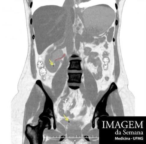 Tomografia computadorizada Análise da Imagem Imagem 1: Tomografia computadorizada de abdome e pelve, reconstrução coronal, sem meio de contraste, evidenciando o rim e a junção