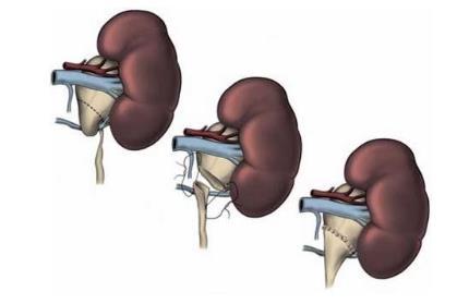 Figura 1: Técnica de Anderson-Hynes: transposição de pelve renal sobre vaso anômalo, que causava estreitamento da JUP.