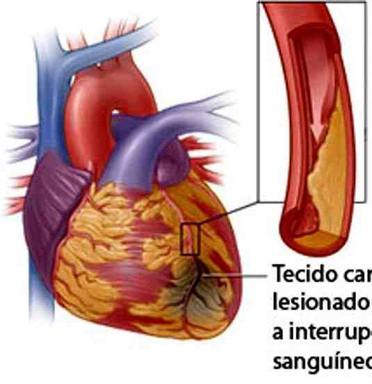 Enfarte do miocárdio Necrose de parte do músculo cardíaco por falta de aporte adequado de O2 e nutrientes, resultante da oclusão de uma artéria coronária.