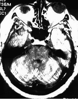 arteriovenosa Na Angiografia Cerebral observou-se, precocemente, imagem do seio cavernoso esquerdo, de calibre irregular