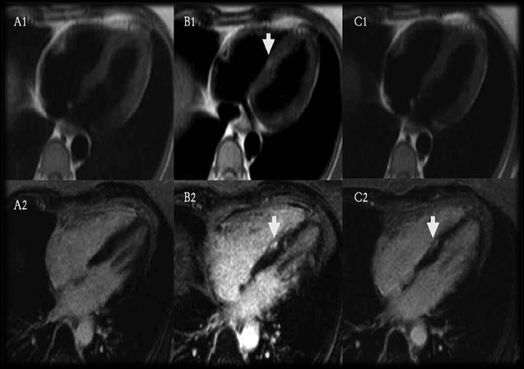 RMC - Pequenas áreas de distribuição difusa de edema (T2) e realce tardio, observadas no mesocárdio e
