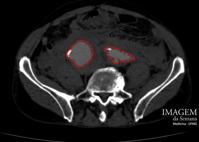 Imagem 3: Tomografia computadorizada da pelve, corte axial, após administração intravenosa de meio de contraste iodado angiotomografia.