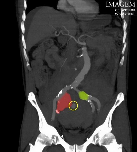Imagem 4: Tomografia computadorizada abdominal e pélvica, reconstrução coronal, após administração intravenosa de meio de contraste iodado angiotomografia. Aorta abdominal tortuosa.