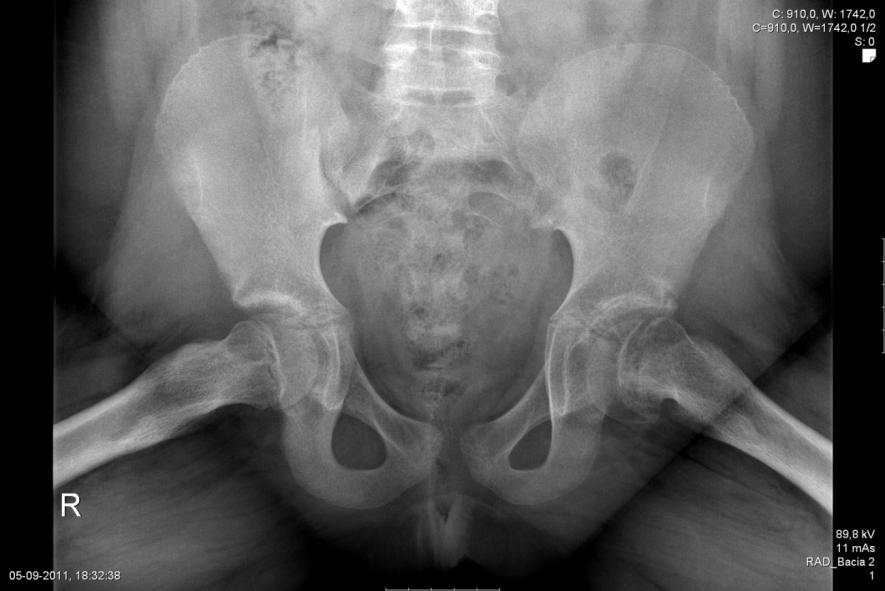 Figura 4: Epifisiólise femoral superior crónica (gentilmente cedida pelo Hospital Pediátrico de Coimbra) A aguda sobre crónica ocorre quando o doente com epifisiólise femoral superior crónica