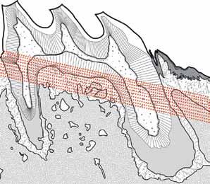 Nas demais raízes (distovestibular, intermediária, distopalatina e mesiopalatina), a estrutura mais delicada acentua exuberantemente os efeitos das forças sobre os tecidos periodontais.